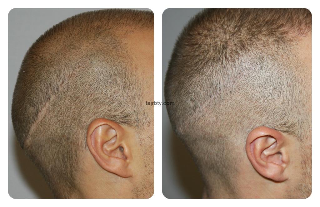 شكل الرأس بعد عملية زراعة الشعر