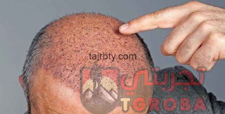 زراعة الشعر في تركيا تجربتي