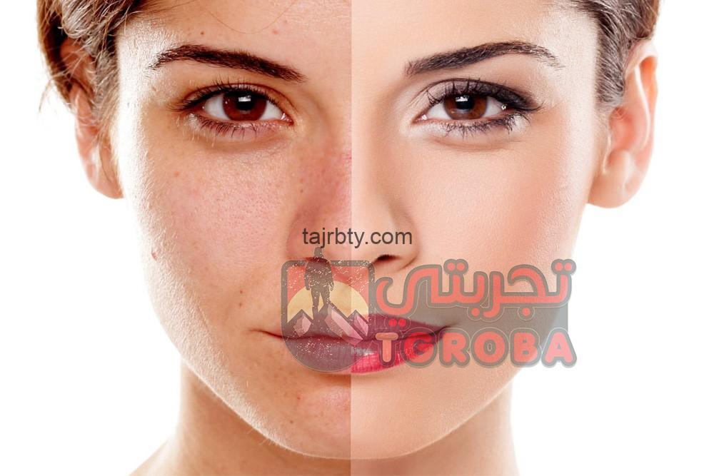 علاج الكلف