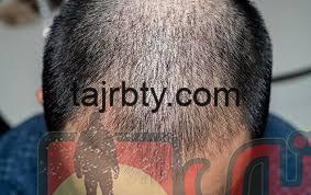 تجارب زراعة الشعر عند الدكتور يتكين باير 2020