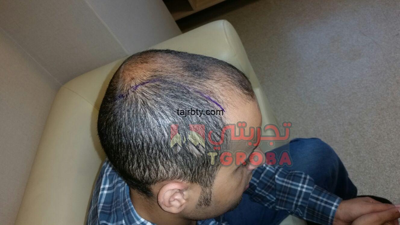 تجربتي لزراعة الشعر في انفنتي هير