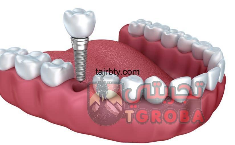 تجربتي مع زراعة الاسنان في مصر