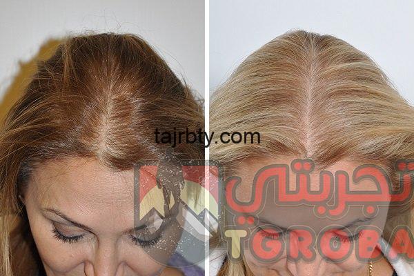 زراعة الشعر في مصر