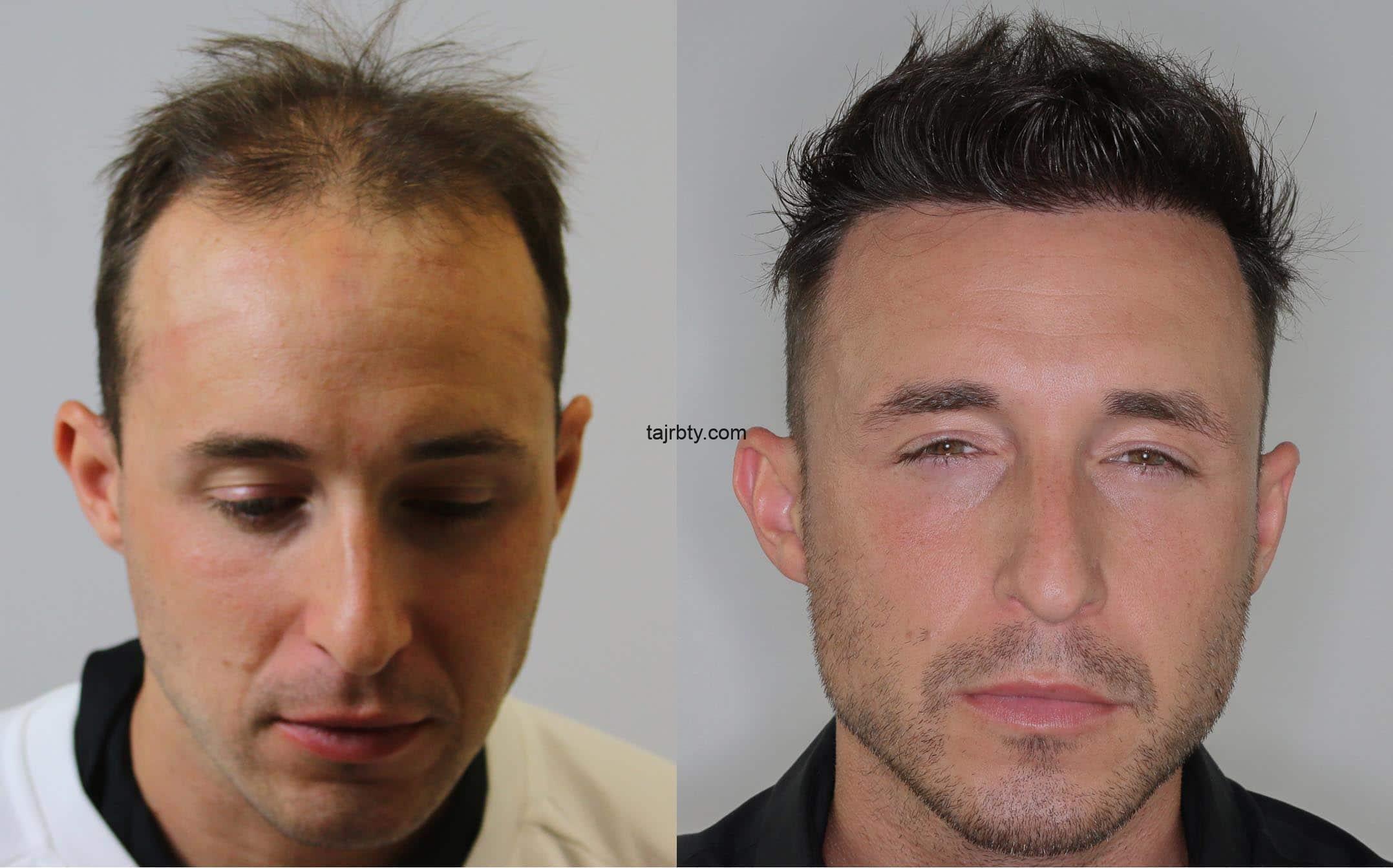 افضل مراكز زراعة الشعر في تركيا 2020