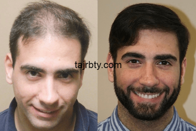 تكلفة زراعة الشعر في تركيا