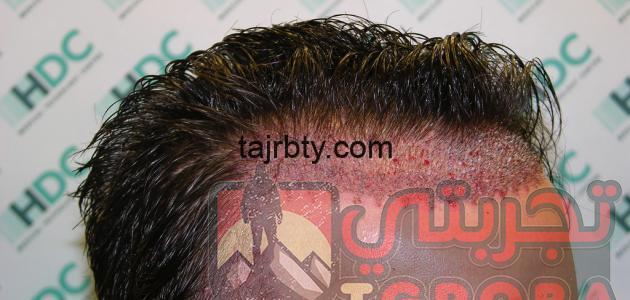 حكم زراعة الشعر تجربتي