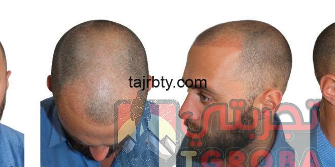 زراعة الشعر في السعودية 2021 تجربتي