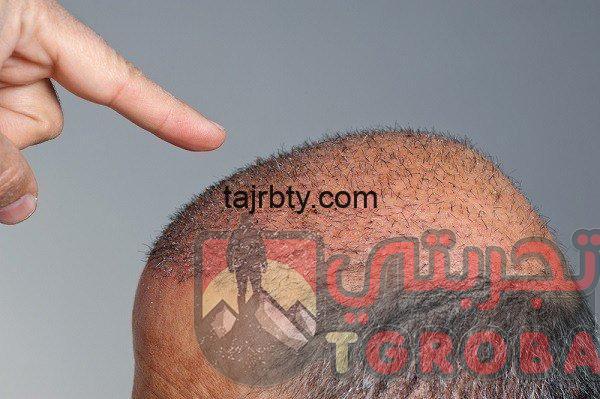زراعة الشعر في جدة تجربتي