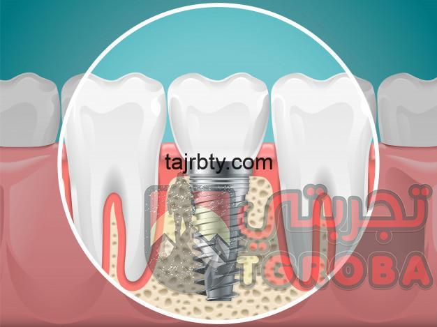 هل تركيب الأسنان مؤلم و أهم مشاكل تركيبات الأسنان الثابتة