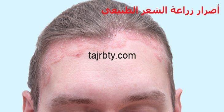 Photo of أضرار زراعة الشعر الطبيعي والآثار الجانبية الأكثر شيوعًا