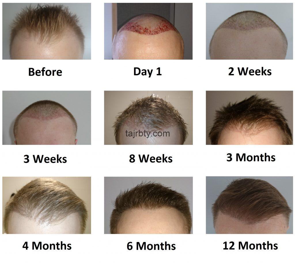 مراحل نمو الشعر المزروع بالصور