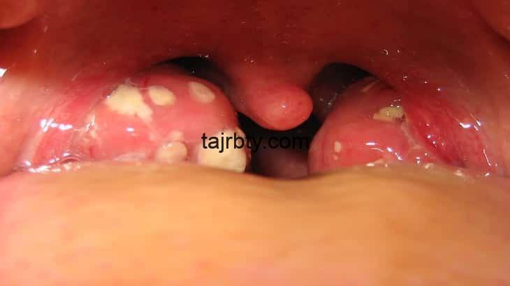 Photo of علاج التهاب الحلق عند الاطفال مجرب