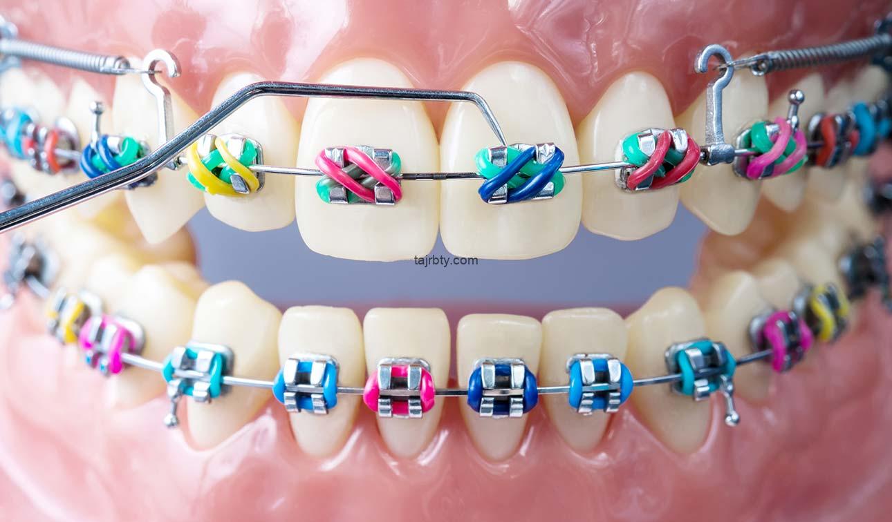 كيف يعمل تقويم الأسنان