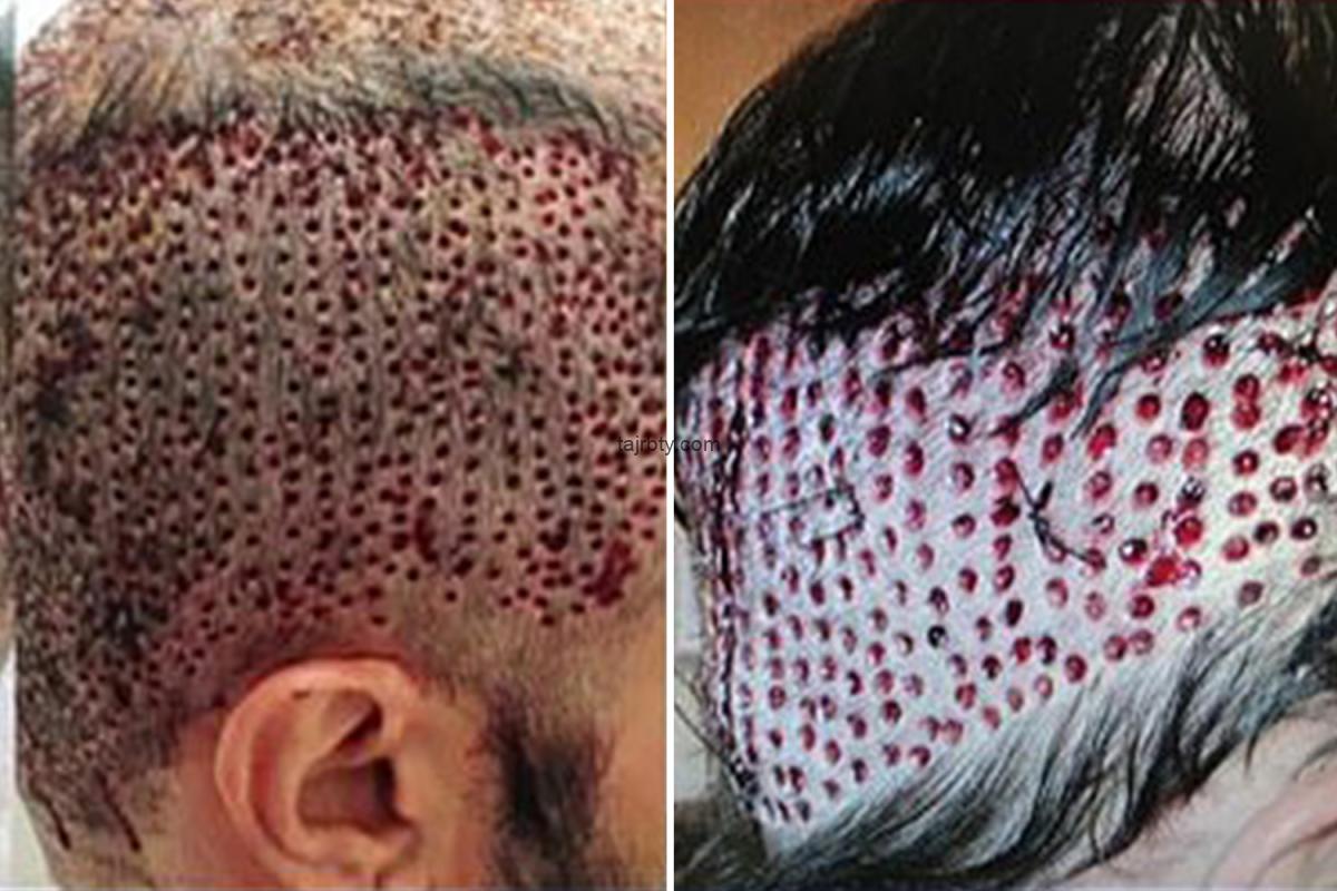 زراعة الشعر في الرياض تجربتي